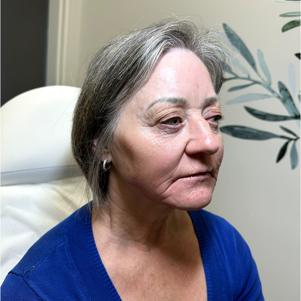 Evergreen MD Aesthetics Filler treatment after