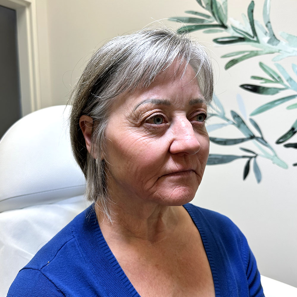 Evergreen MD Aesthetics Filler Treatment Before