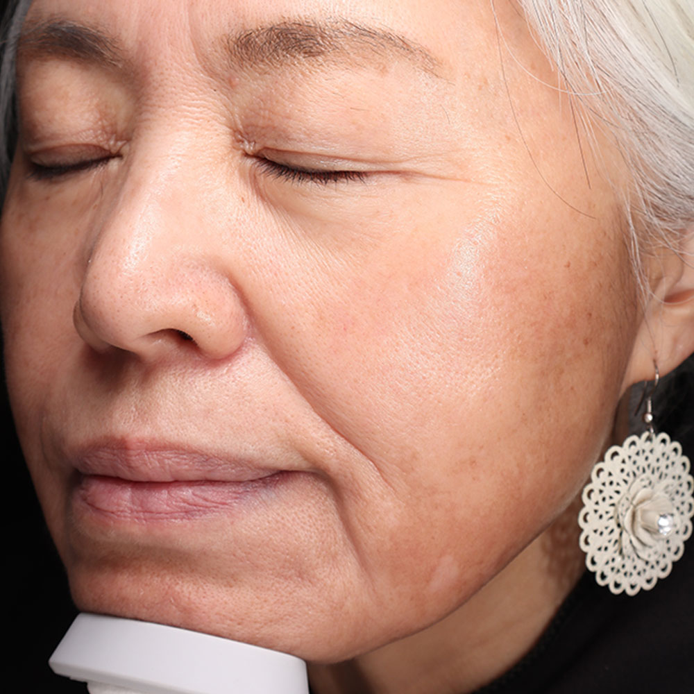 Evergreen MD Aesthetics Moxi/BBL Treatments MK After