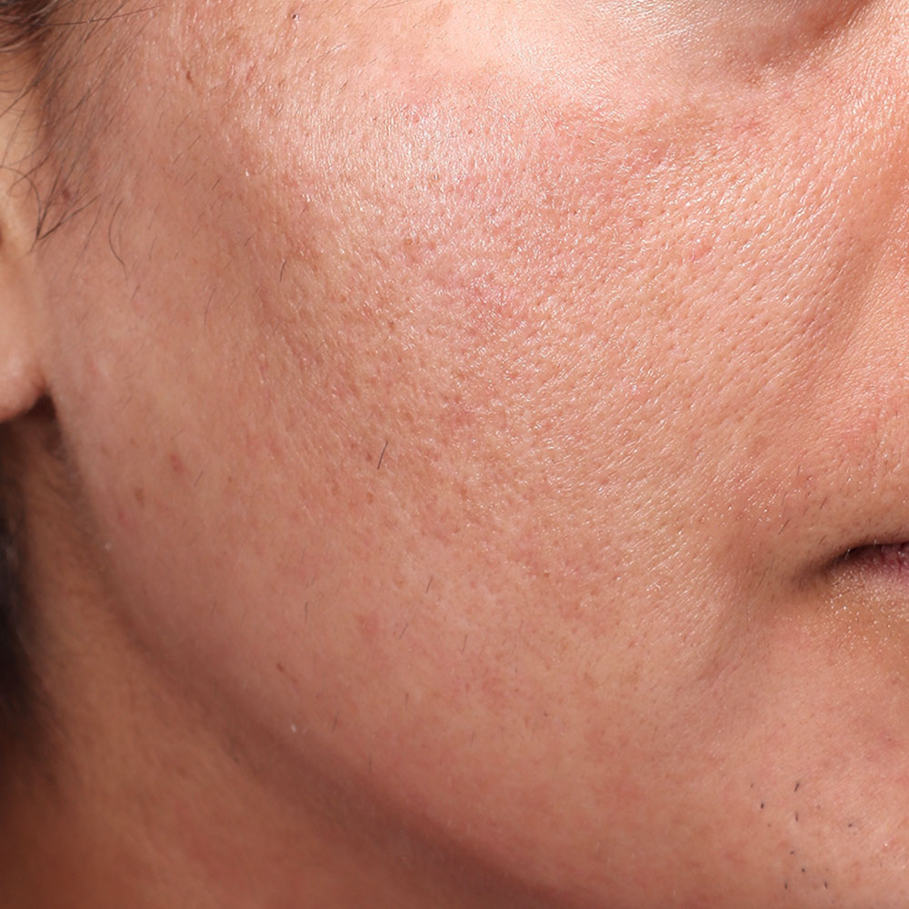 Evergreen MD Aesthetics Moxi/BBL Treatment After