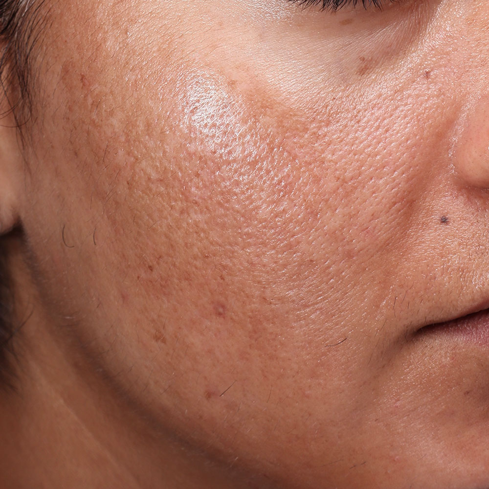 Evergreen MD Aesthetics Moxi/BBL Treatment Before